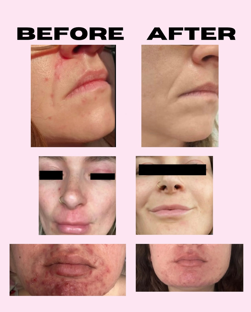 SIV microbiome balancing serum