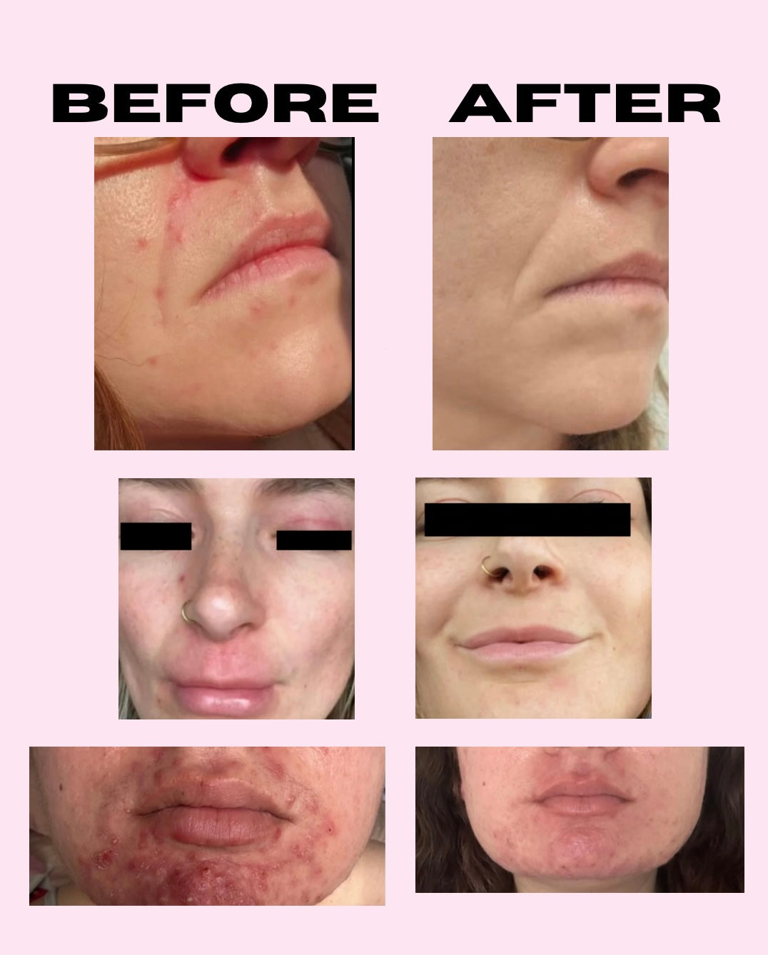 SIV microbiome balancing serum